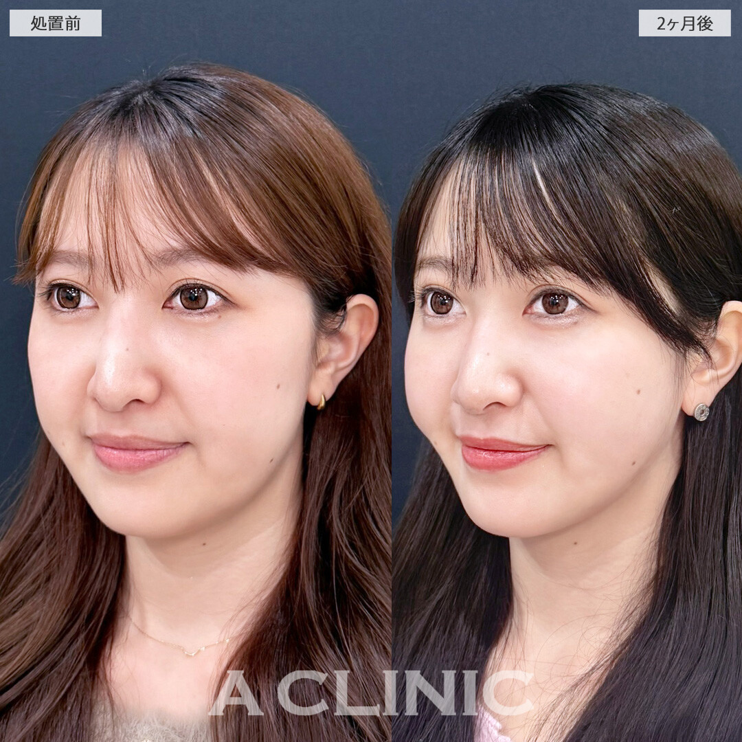 1day小顔脂肪吸引とバッカルファット除去術で余分な脂肪を残さず除去！こちら処置前と2か月後の症例です(30代女性)
