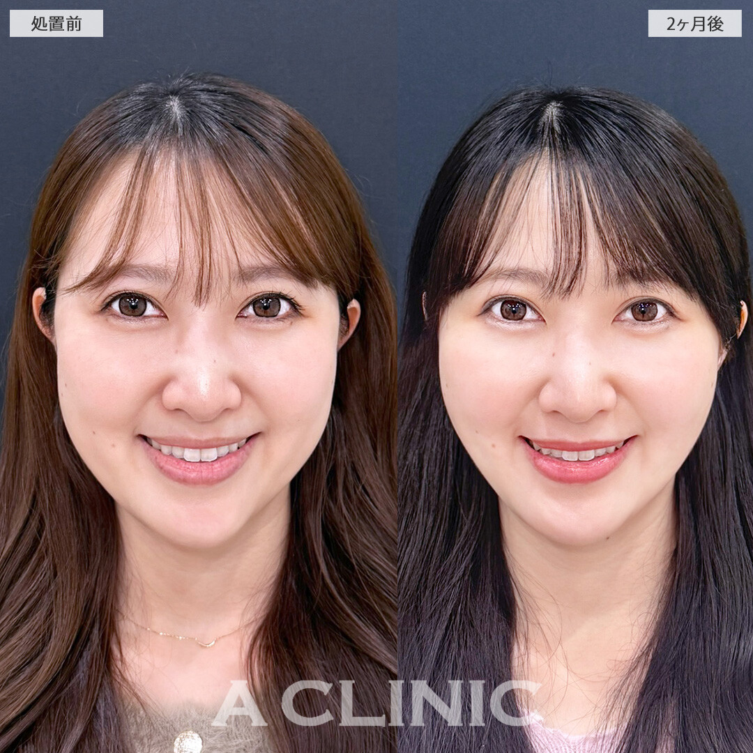1day小顔脂肪吸引とバッカルファット除去術で余分な脂肪を残さず除去！こちら処置前と2か月後の症例です(30代女性)