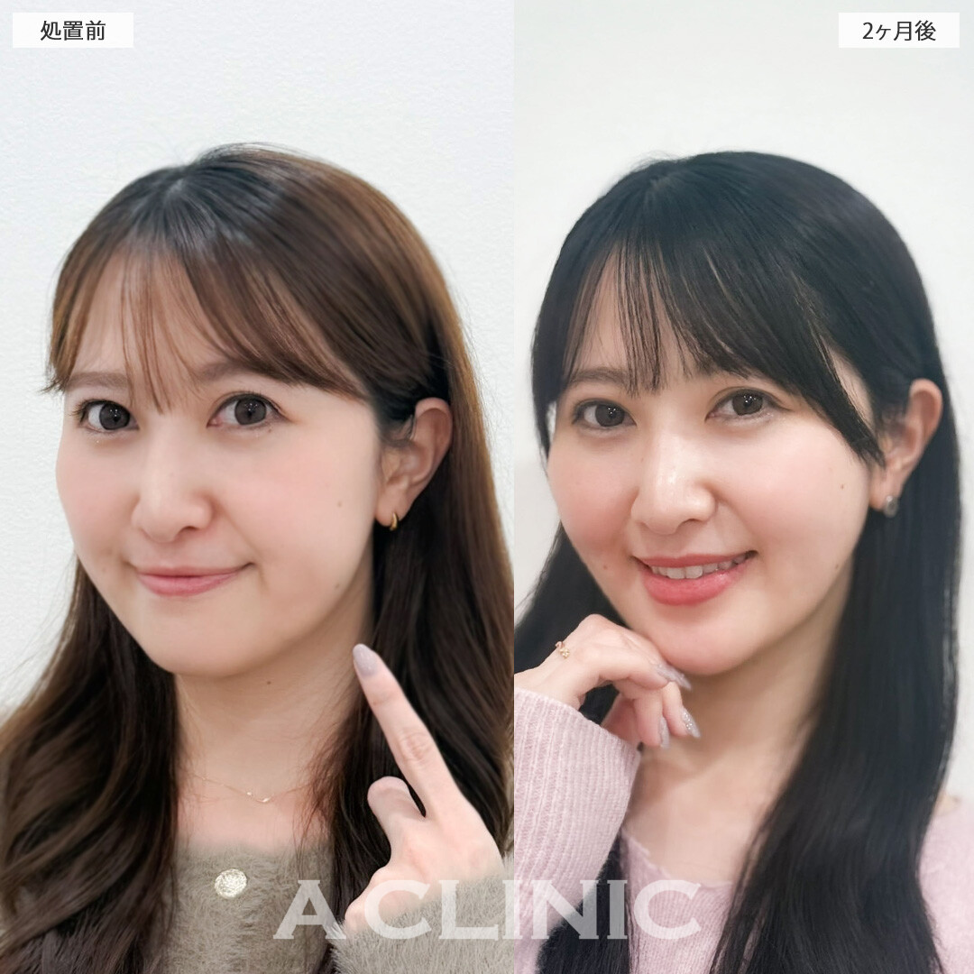 1day小顔脂肪吸引とバッカルファット除去術で余分な脂肪を残さず除去！こちら処置前と2か月後の症例です(30代女性)