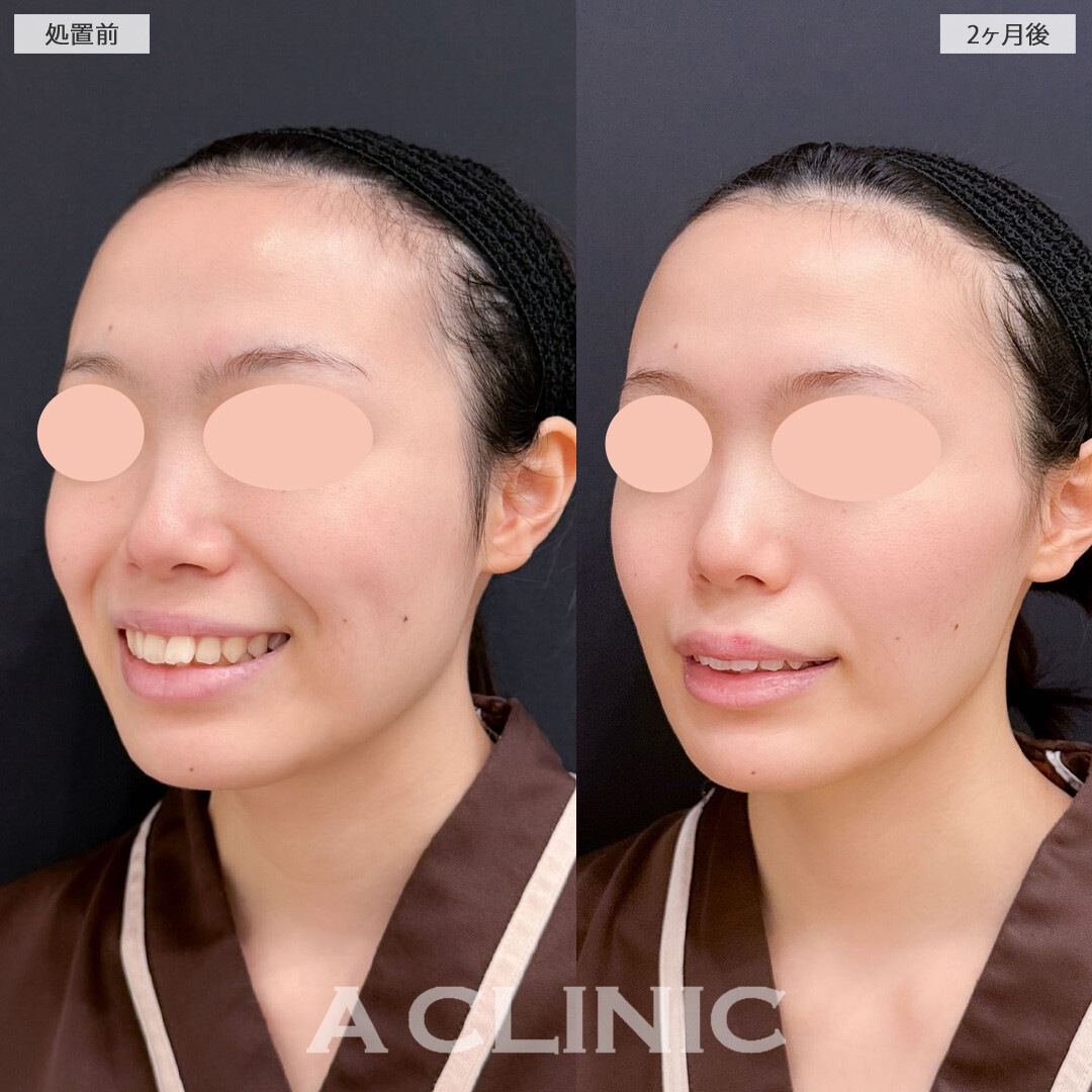 1day小顔脂肪吸引とバッカルファット除去術で気になる脂肪を取り除き洗練された印象に！こちら処置前と2ヶ月後の症例です(20代女性)