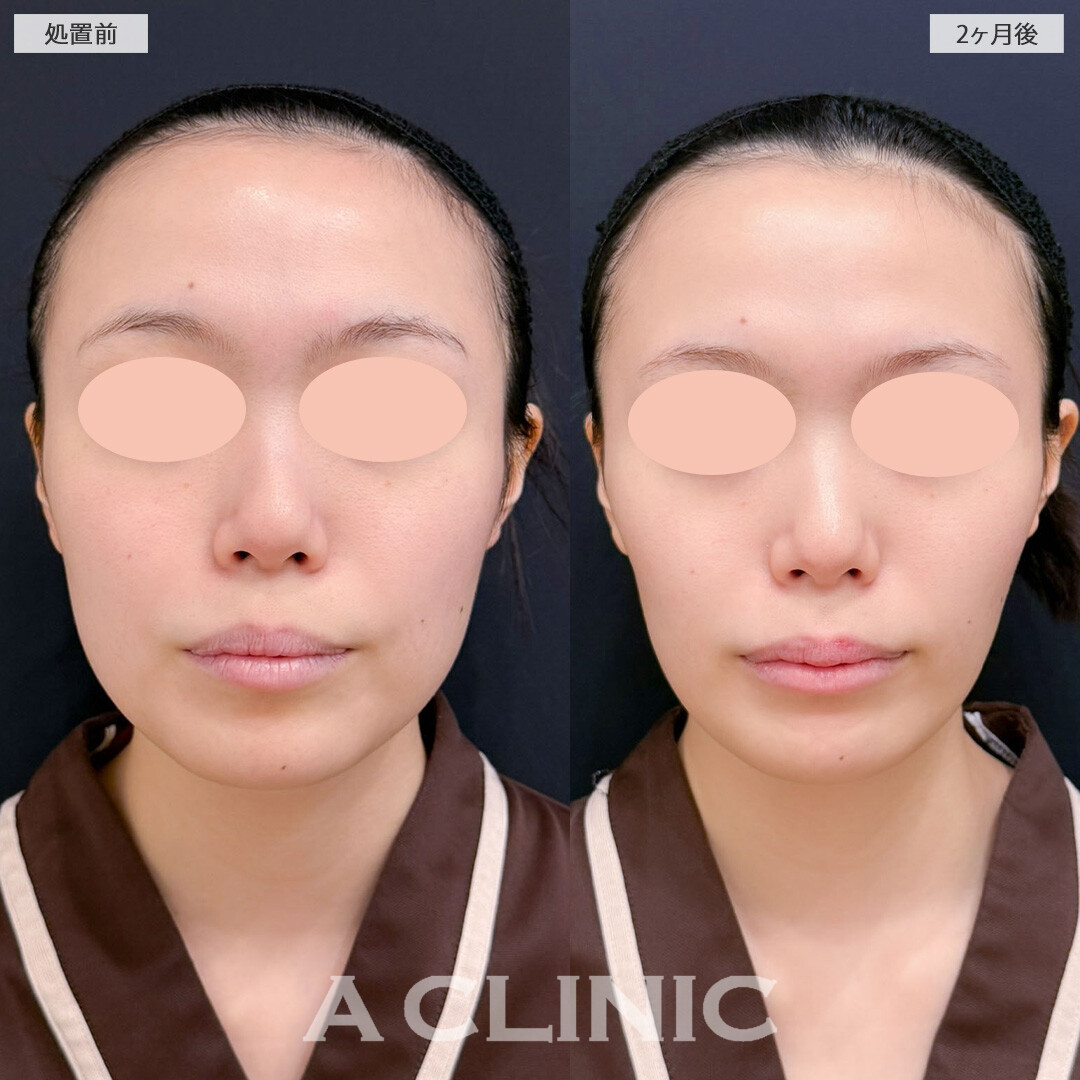 1day小顔脂肪吸引とバッカルファット除去術で気になる脂肪を取り除き洗練された印象に！こちら処置前と2ヶ月後の症例です(20代女性)