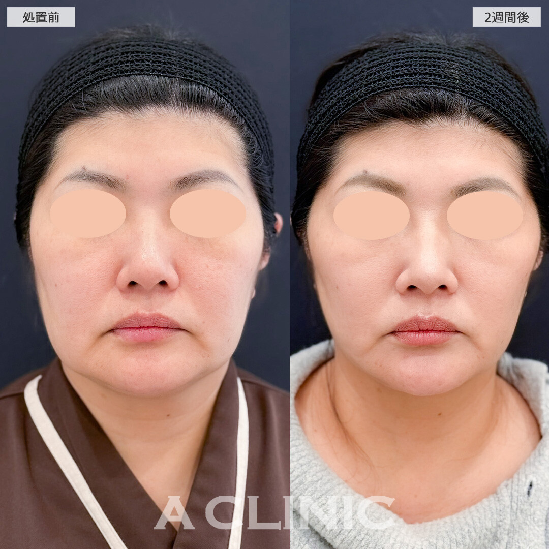1day小顔脂肪吸引で気になる脂肪を一掃して理想の小顔に！こちら処置前と2週間後の症例です(40代女性)
