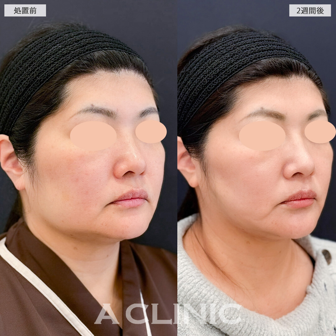 1day小顔脂肪吸引で気になる脂肪を一掃して理想の小顔に！こちら処置前と2週間後の症例です(40代女性)