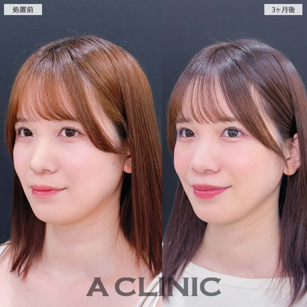 1day小顔脂肪吸引でお顔が一回り小さくなり写真写りも良くなります！こちら処置前と3か月後の症例です(20代女性)