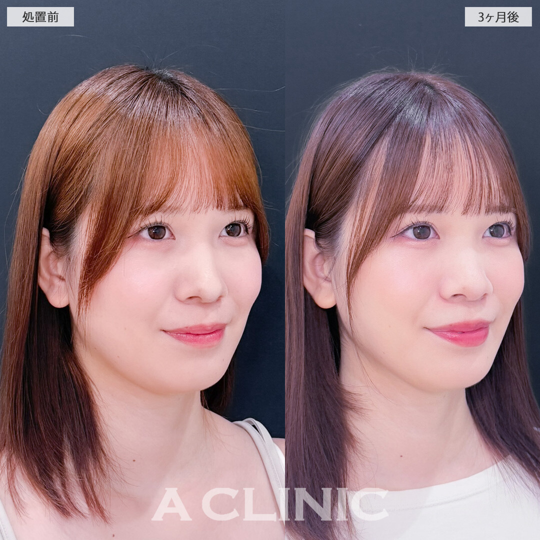1day小顔脂肪吸引でお顔が一回り小さくなり写真写りも良くなります！こちら処置前と3か月後の症例です(20代女性)