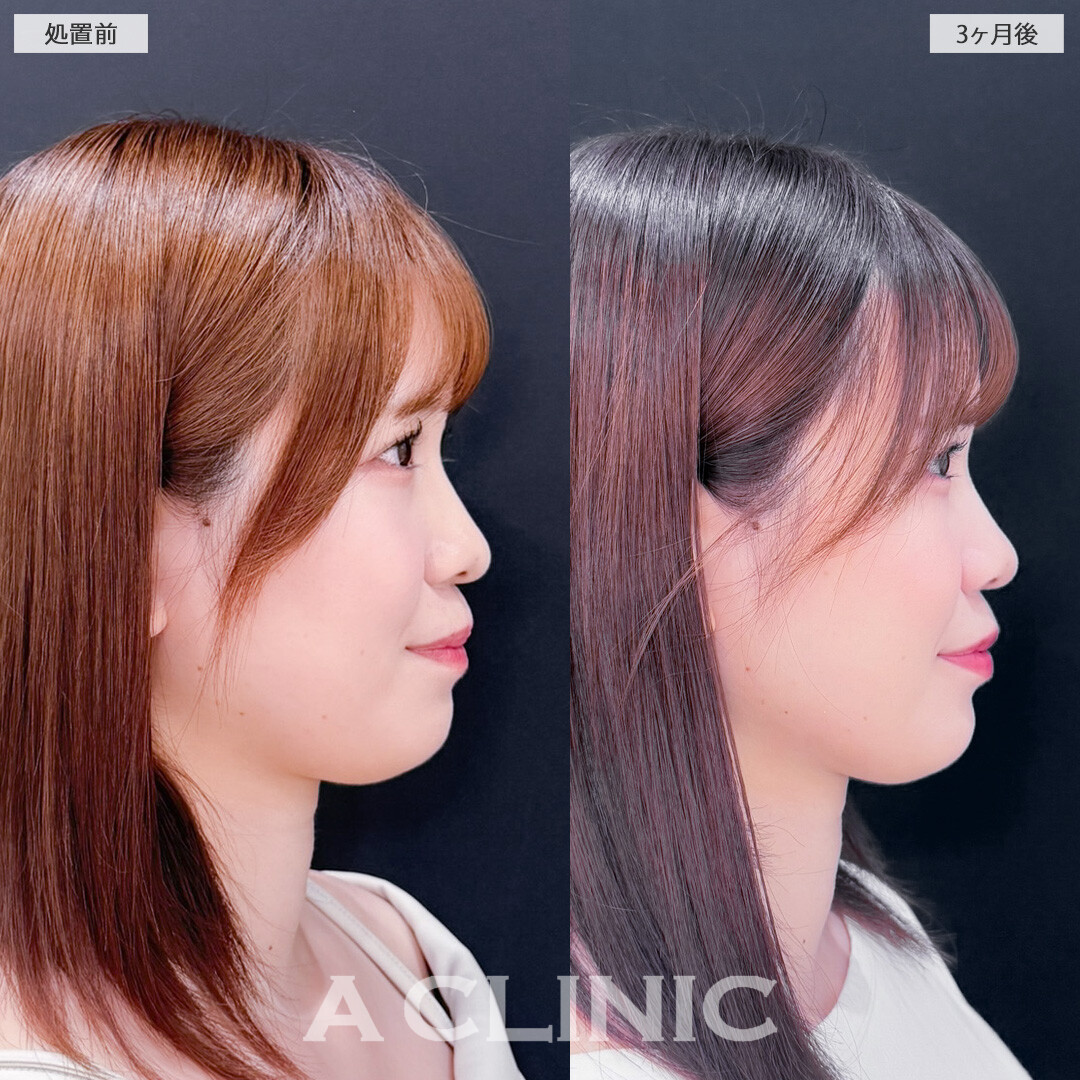 1day小顔脂肪吸引でお顔が一回り小さくなり写真写りも良くなります！こちら処置前と3か月後の症例です(20代女性)