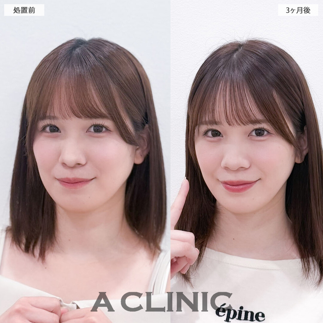 1day小顔脂肪吸引でお顔が一回り小さくなり写真写りも良くなります！こちら処置前と3か月後の症例です(20代女性)