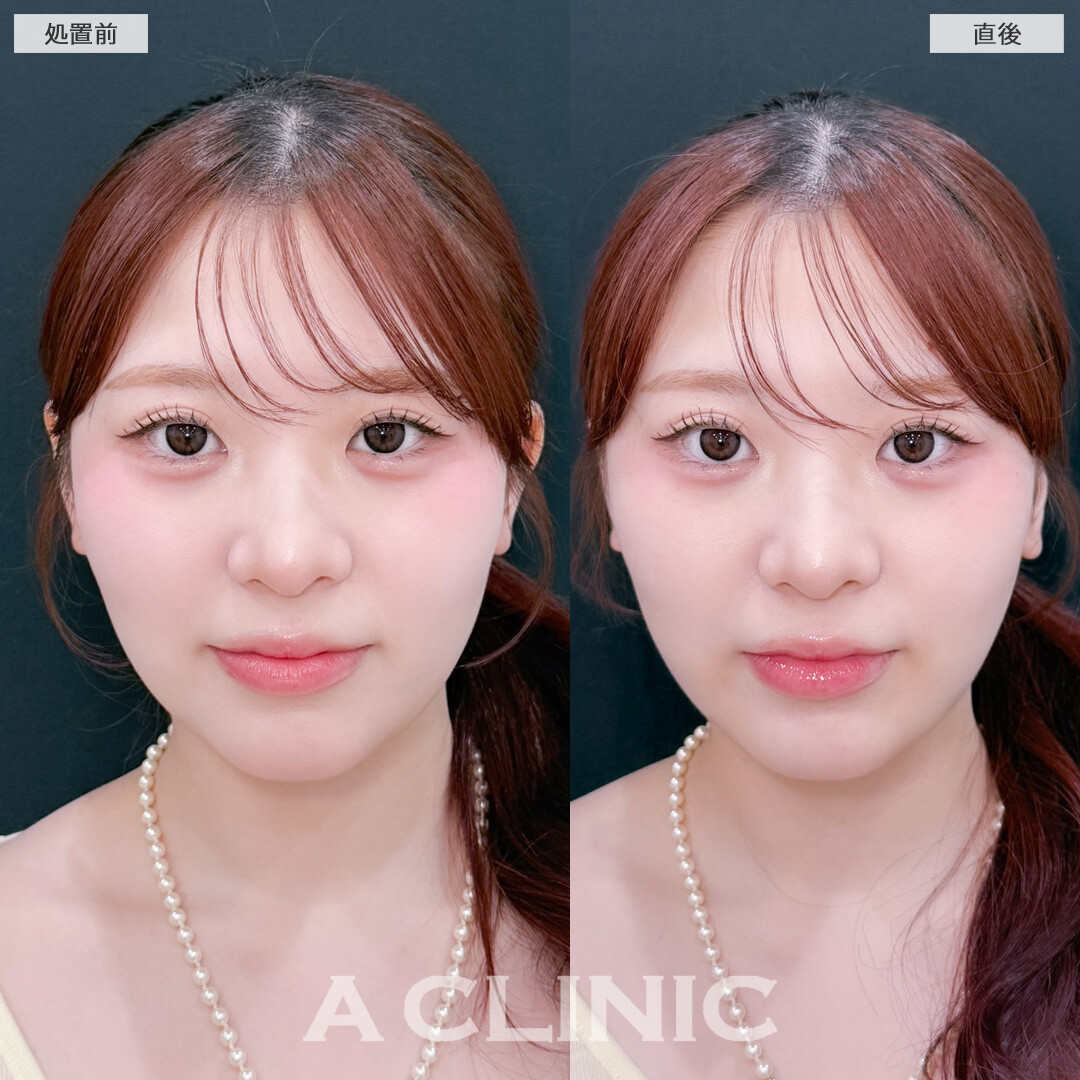 1day小顔脂肪吸引でダウンタイム少なく小顔に！こちら処置前と直後の症例です(20代女性)