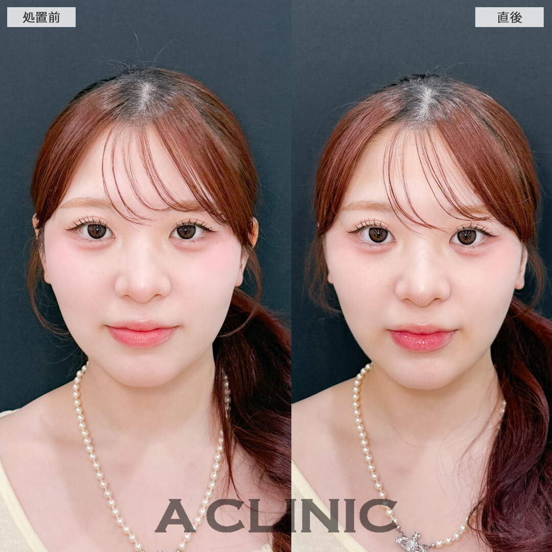 1day小顔脂肪吸引でダウンタイム少なく小顔に！こちら処置前と直後の症例です(20代女性)