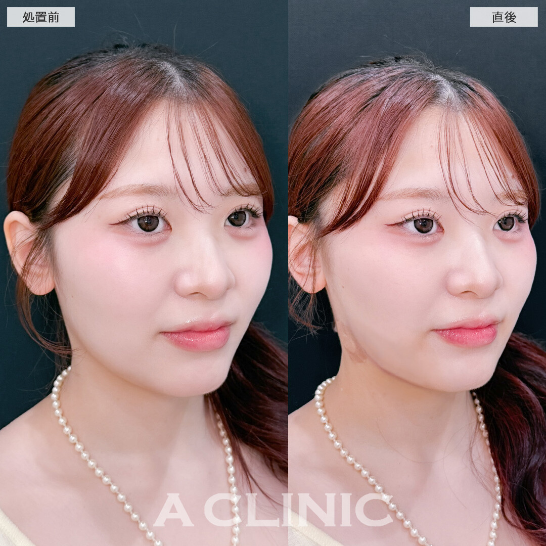 1day小顔脂肪吸引でダウンタイム少なく小顔に！こちら処置前と直後の症例です(20代女性)