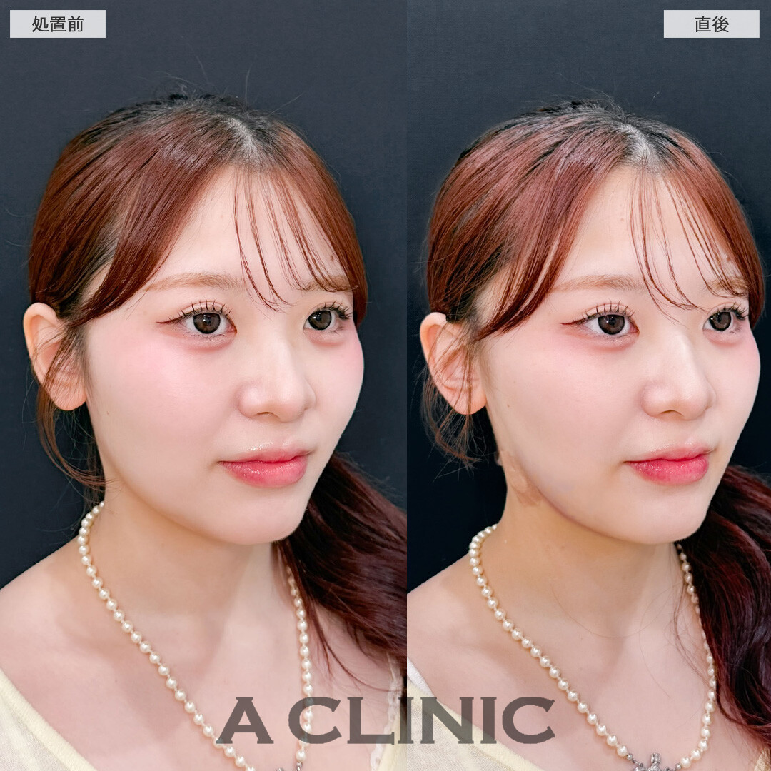 1day小顔脂肪吸引でダウンタイム少なく小顔に！こちら処置前と直後の症例です(20代女性)
