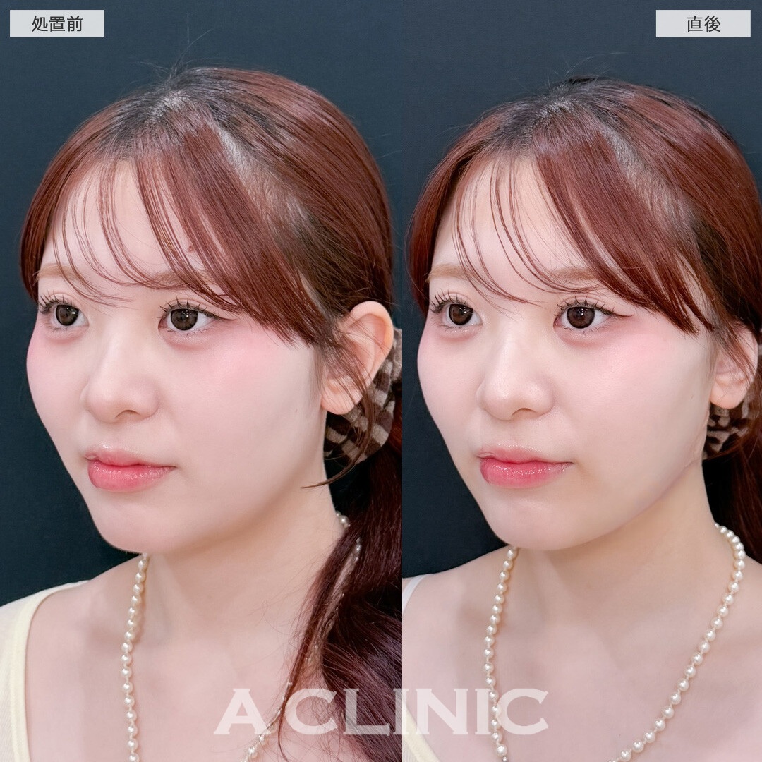 1day小顔脂肪吸引でダウンタイム少なく小顔に！こちら処置前と直後の症例です(20代女性)