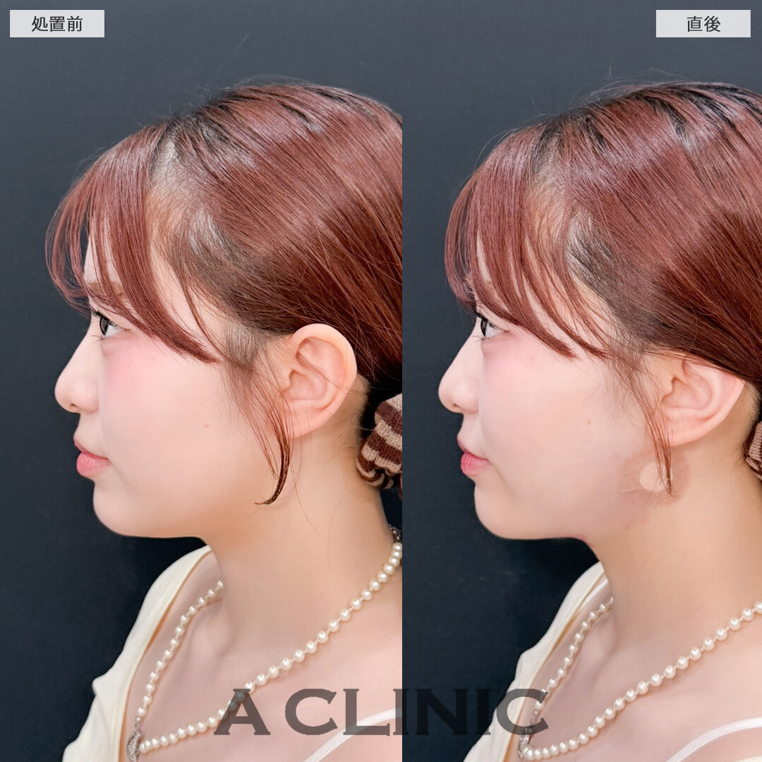 1day小顔脂肪吸引でダウンタイム少なく小顔に！こちら処置前と直後の症例です(20代女性)
