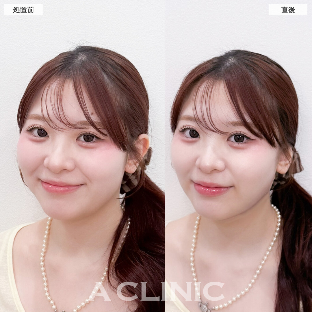 1day小顔脂肪吸引でダウンタイム少なく小顔に！こちら処置前と直後の症例です(20代女性)