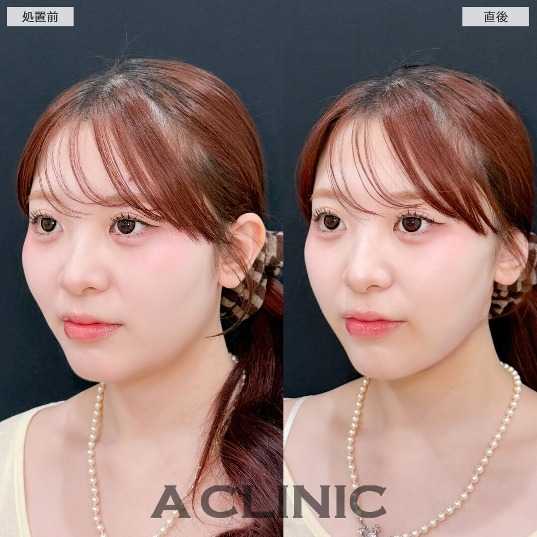 1day小顔脂肪吸引でダウンタイム少なく小顔に！こちら処置前と直後の症例です(20代女性)