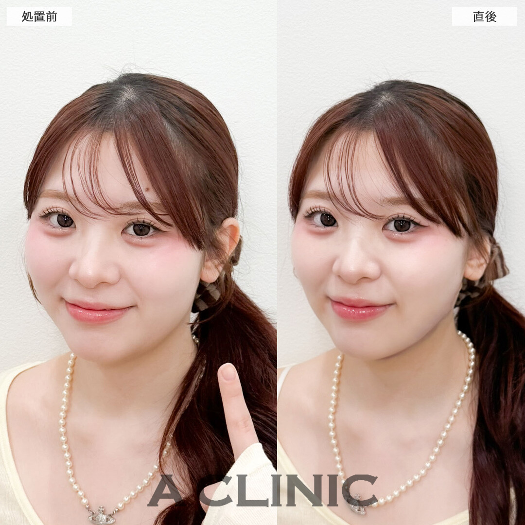 1day小顔脂肪吸引でダウンタイム少なく小顔に！こちら処置前と直後の症例です(20代女性)