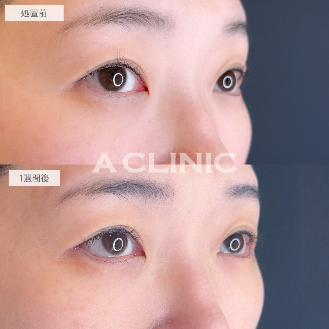 パーフェクトアイズで優しい印象の目元に印象チェンジ！こちら処置前と1週間後の症例です(40代女性)