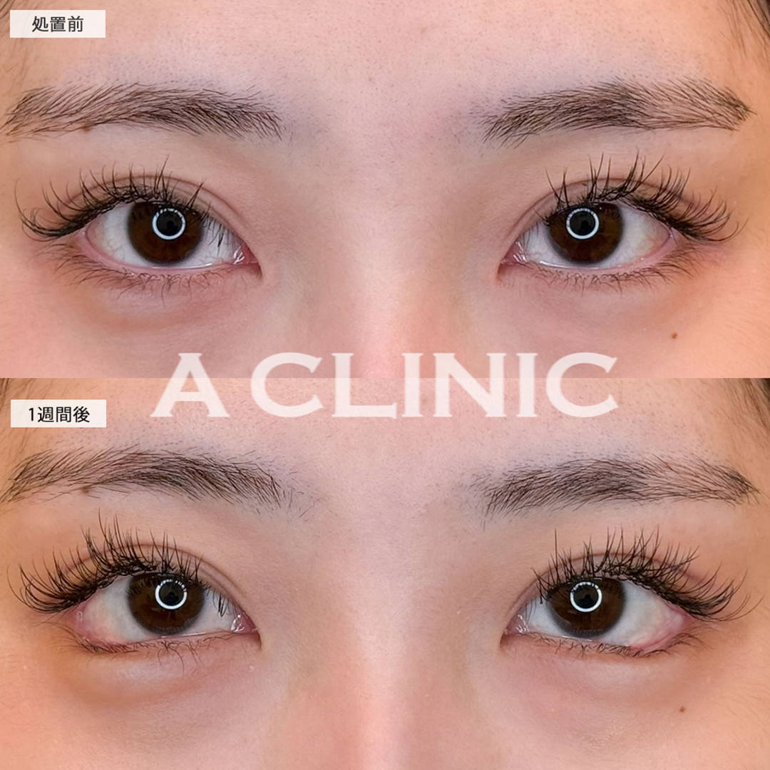 パーフェクトアイズでたれ目が爆誕し可愛いお目元に！こちら処置前と1週間後の症例です(20代女性)