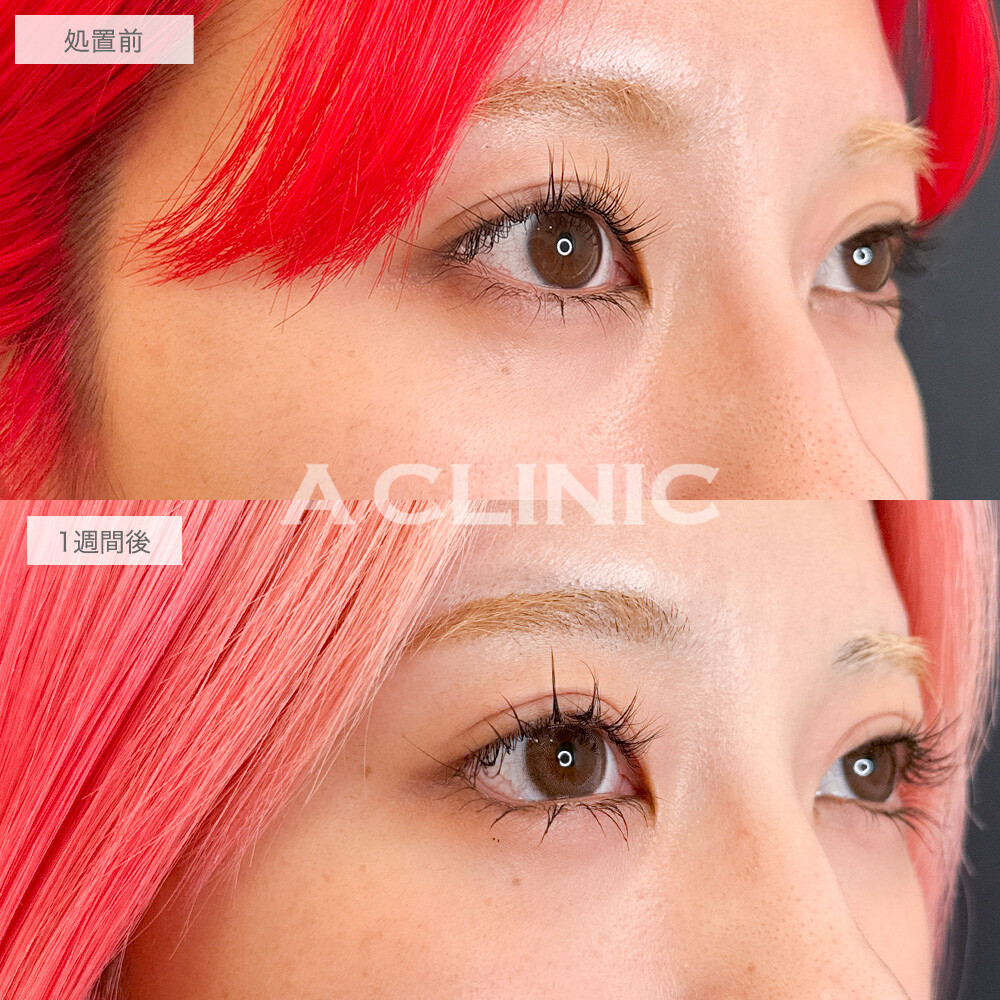 パーフェクトアイズで目の左右差改善！処置前と1週間後の症例です(20代女性)