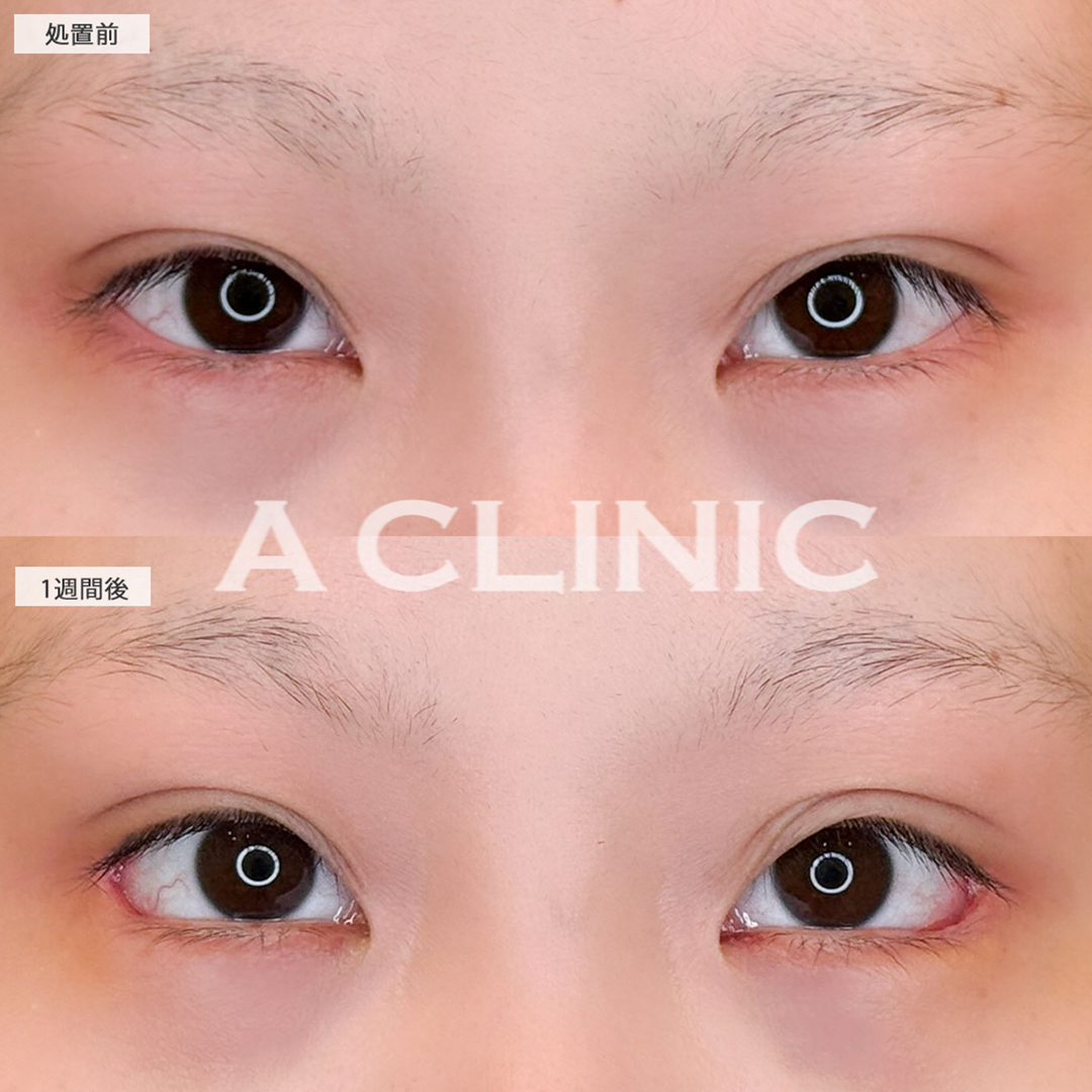 パーフェクトアイズで流行のたれ目になりメイクをするのが楽しくなりました！こちら処置前と1週間後の症例です(20代女性)
