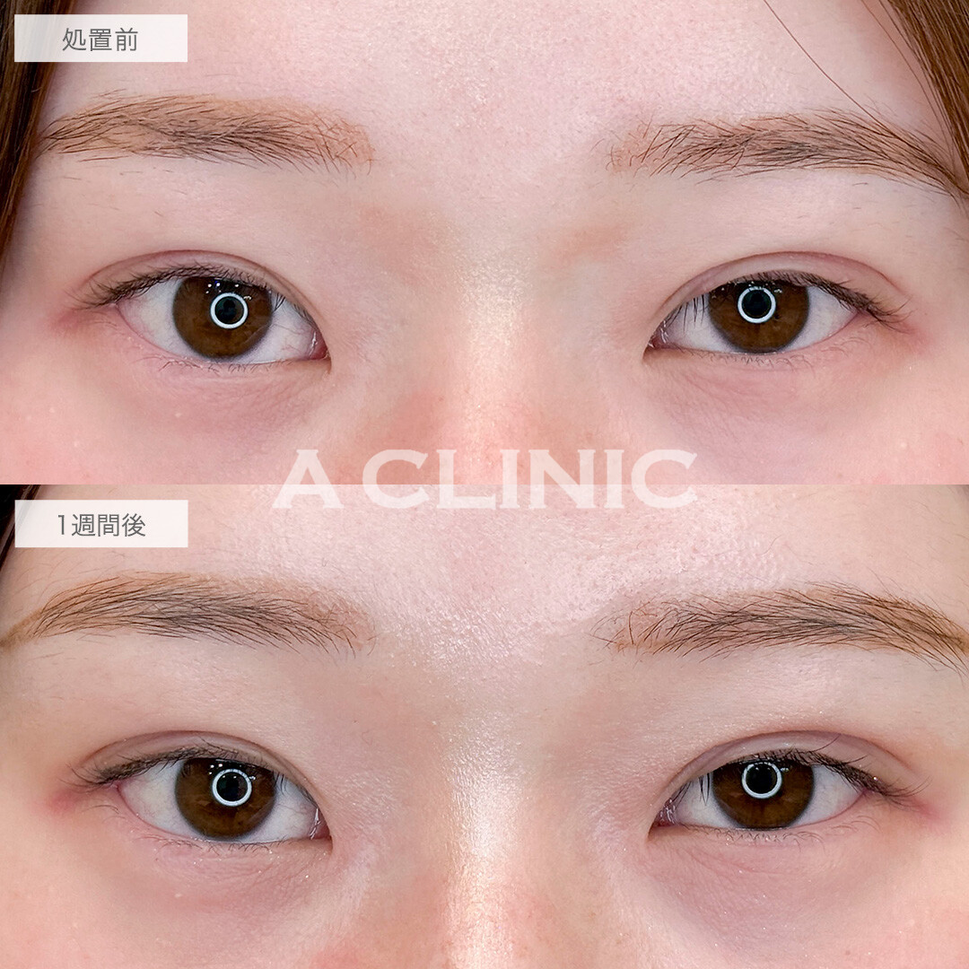 パーフェクトアイズで自然に大きな目になりました！処置前と1週間後の症例です(20代女性)