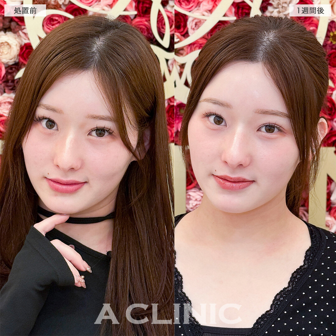 パーフェクトアイズで自然に大きな目になりました！処置前と1週間後の症例です(20代女性)