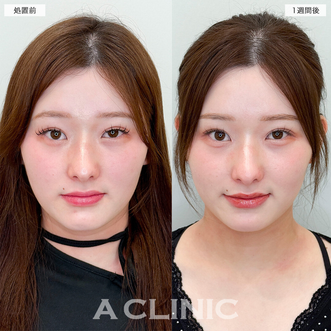 パーフェクトアイズで自然に大きな目になりました！処置前と1週間後の症例です(20代女性)