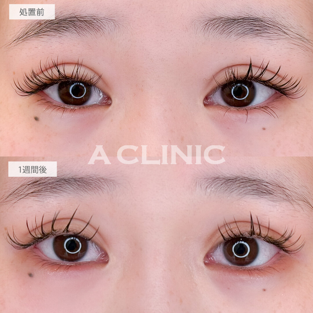 パーフェクトアイズで目の横幅も縦幅も大きくなりました！処置前と1週間後の症例です(20代女性)