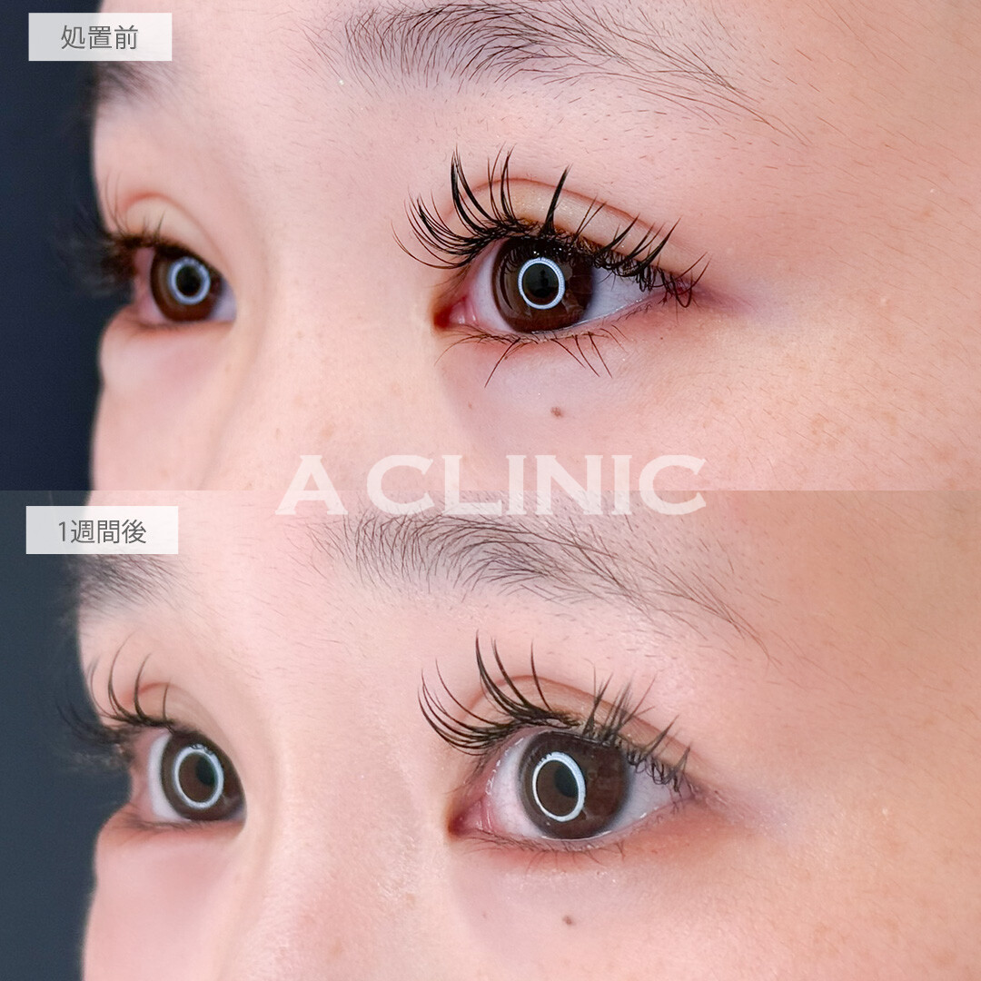 パーフェクトアイズで目の横幅も縦幅も大きくなりました！処置前と1週間後の症例です(20代女性)