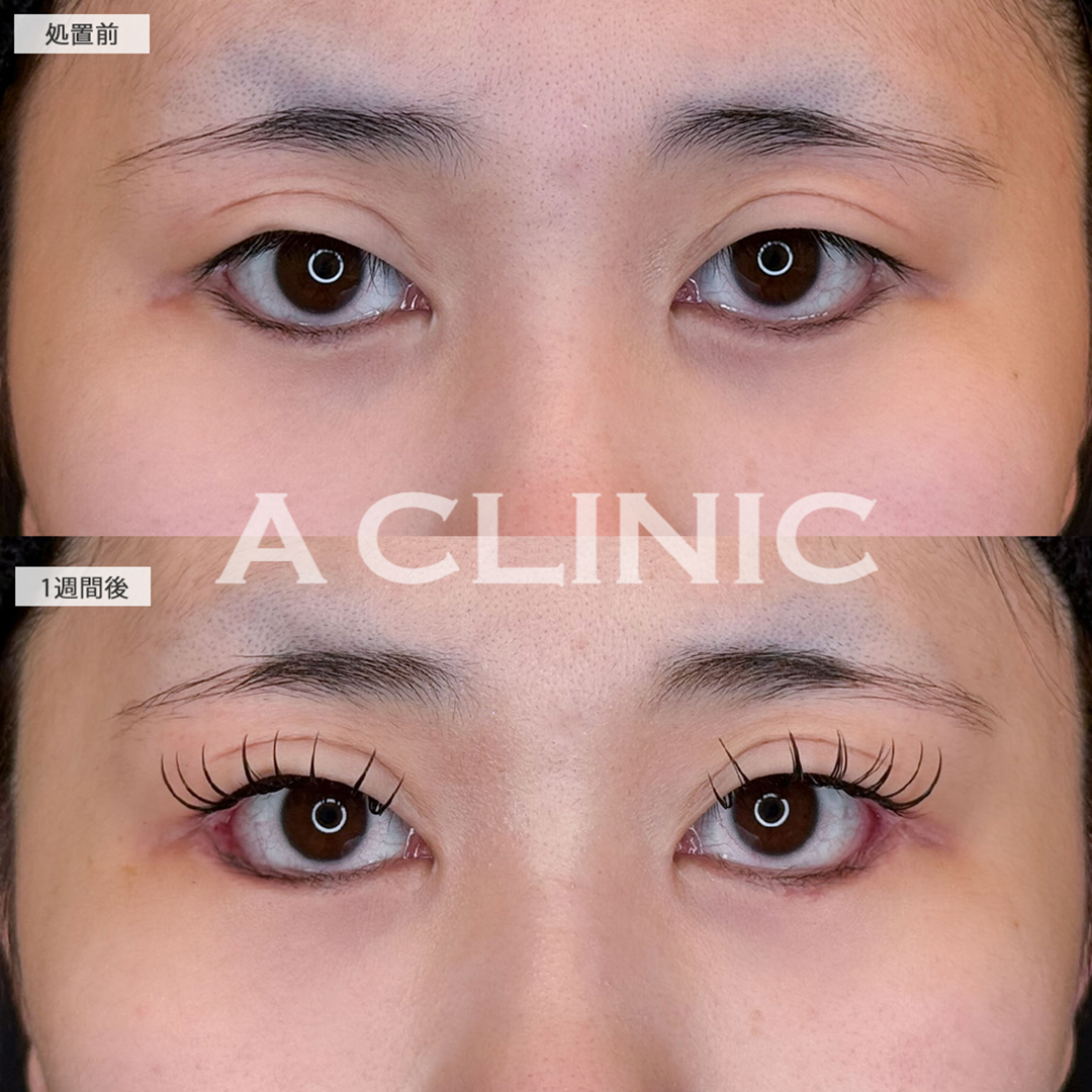 パーフェクトアイズで一回り目が大きくなりました！こちら処置前と1週間後の症例です(20代女性)