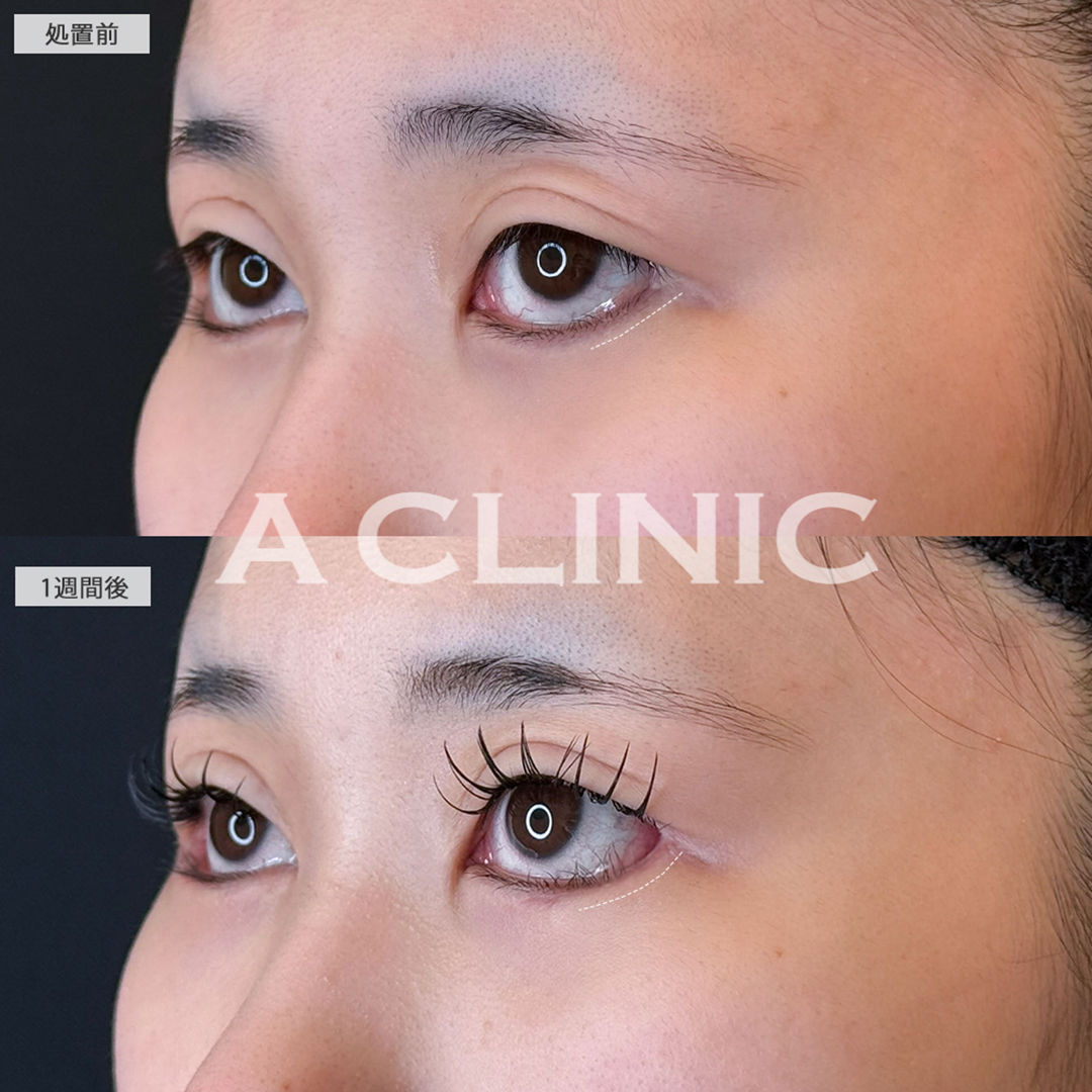 パーフェクトアイズで一回り目が大きくなりました！こちら処置前と1週間後の症例です(20代女性)