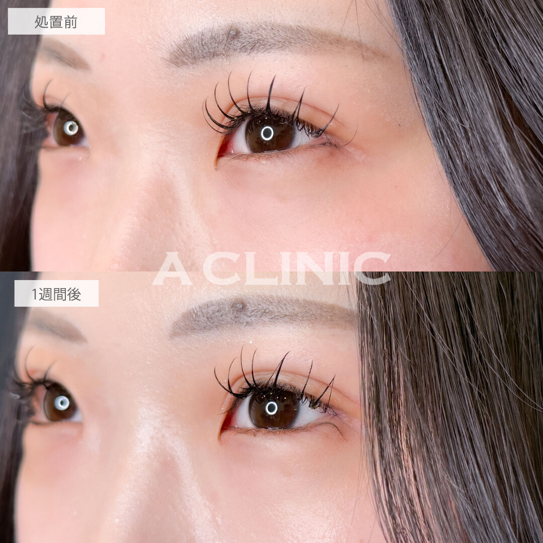 パーフェクトアイズで気になるつり目も大きさも同時に改善！こちら処置前と一週間後の症例です(20代女性)