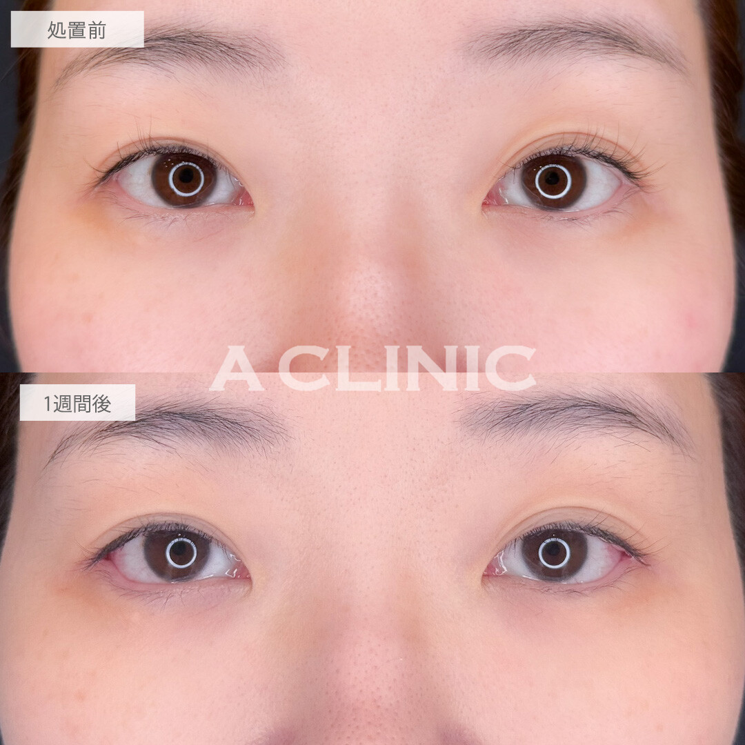 パーフェクトアイズで優しい印象の目元に印象チェンジ！こちら処置前と1週間後の症例です(40代女性)
