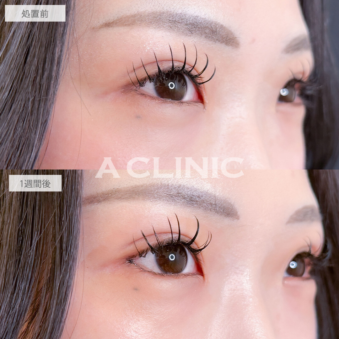 パーフェクトアイズで気になるつり目も大きさも同時に改善！こちら処置前と一週間後の症例です(20代女性)