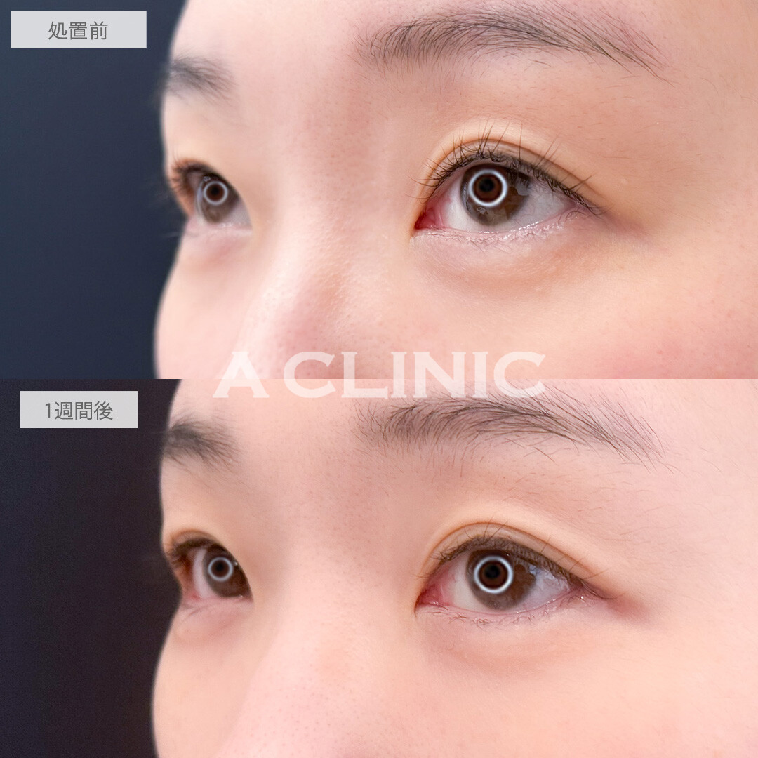 パーフェクトアイズで優しい印象の目元に印象チェンジ！こちら処置前と1週間後の症例です(40代女性)