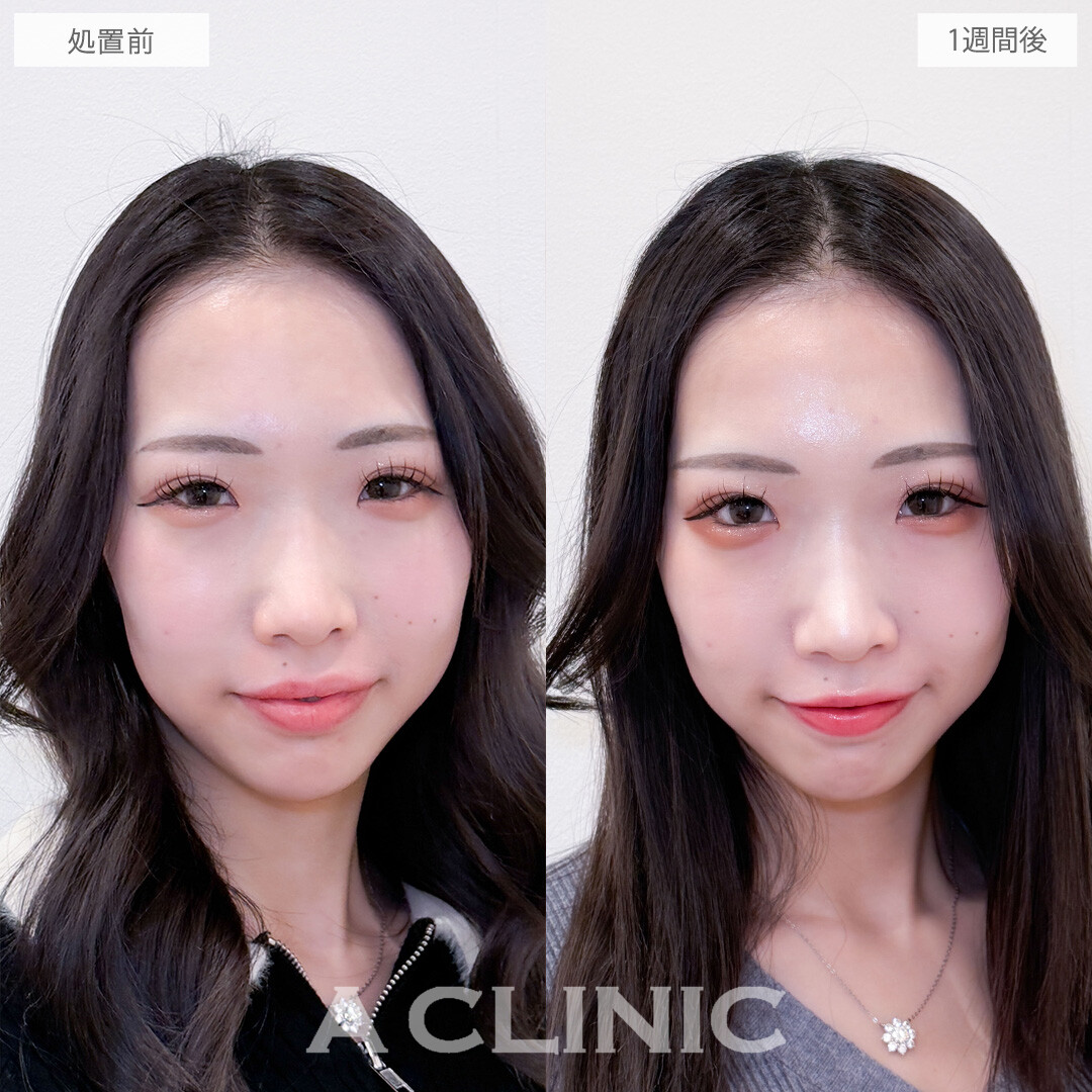 パーフェクトアイズで気になるつり目も大きさも同時に改善！こちら処置前と一週間後の症例です(20代女性)