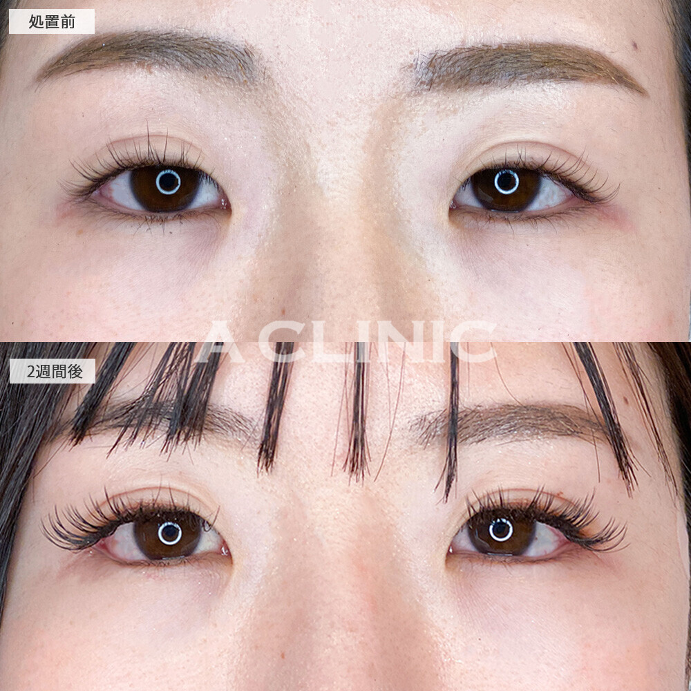 パーフェクトアイズでタレ目になりより優しい目元に！こちら処置前と2週間後の症例です(20代女性)