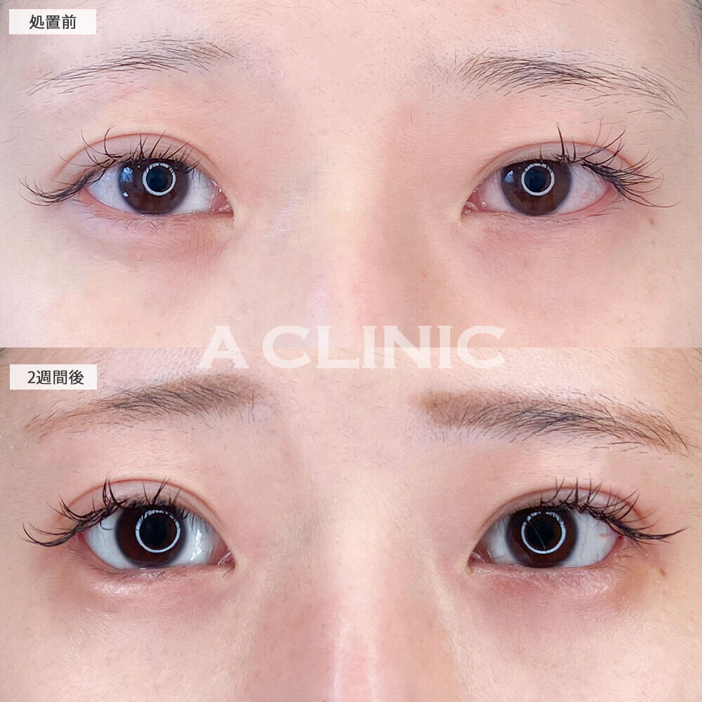 パーフェクトアイズで優しい大きな目元に！こちら処置前と2週間後の症例です(30代女性)