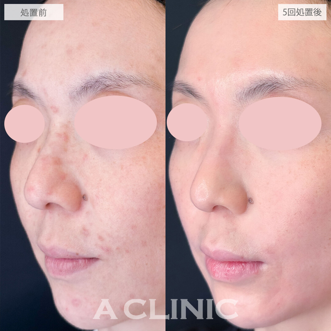 ポテンツァとケミカルピーリングで治りにくい大人ニキビもきれいに治りました！こちら処置前と5回処置後の症例です(30代女性)