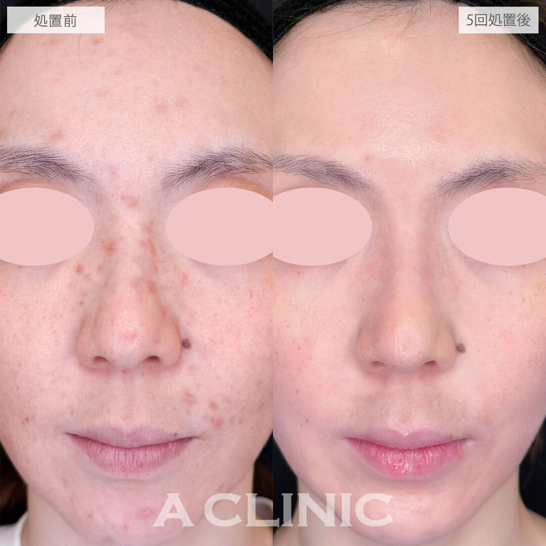 ポテンツァとケミカルピーリングで治りにくい大人ニキビもきれいに治りました！こちら処置前と5回処置後の症例です(30代女性)