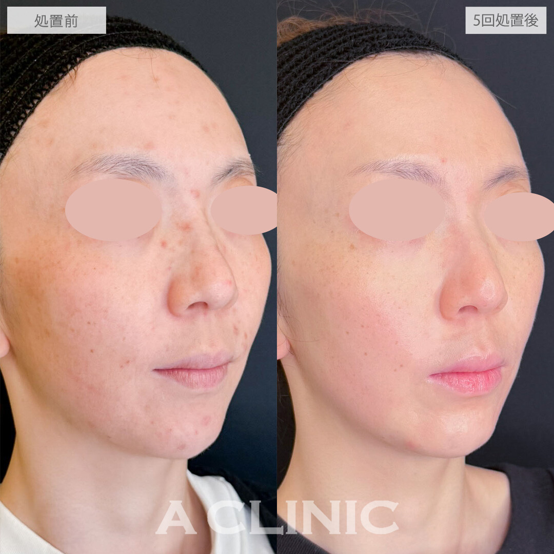 ポテンツァとケミカルピーリングで治りにくい大人ニキビもきれいに治りました！こちら処置前と5回処置後の症例です(30代女性)
