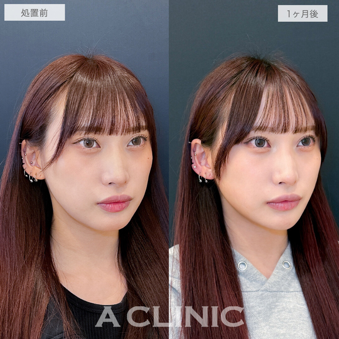 1day小顔脂肪吸引で輪郭が整い美人度がさらにパワーアップ！処置前と1ヶ月後の症例です(20代女性)