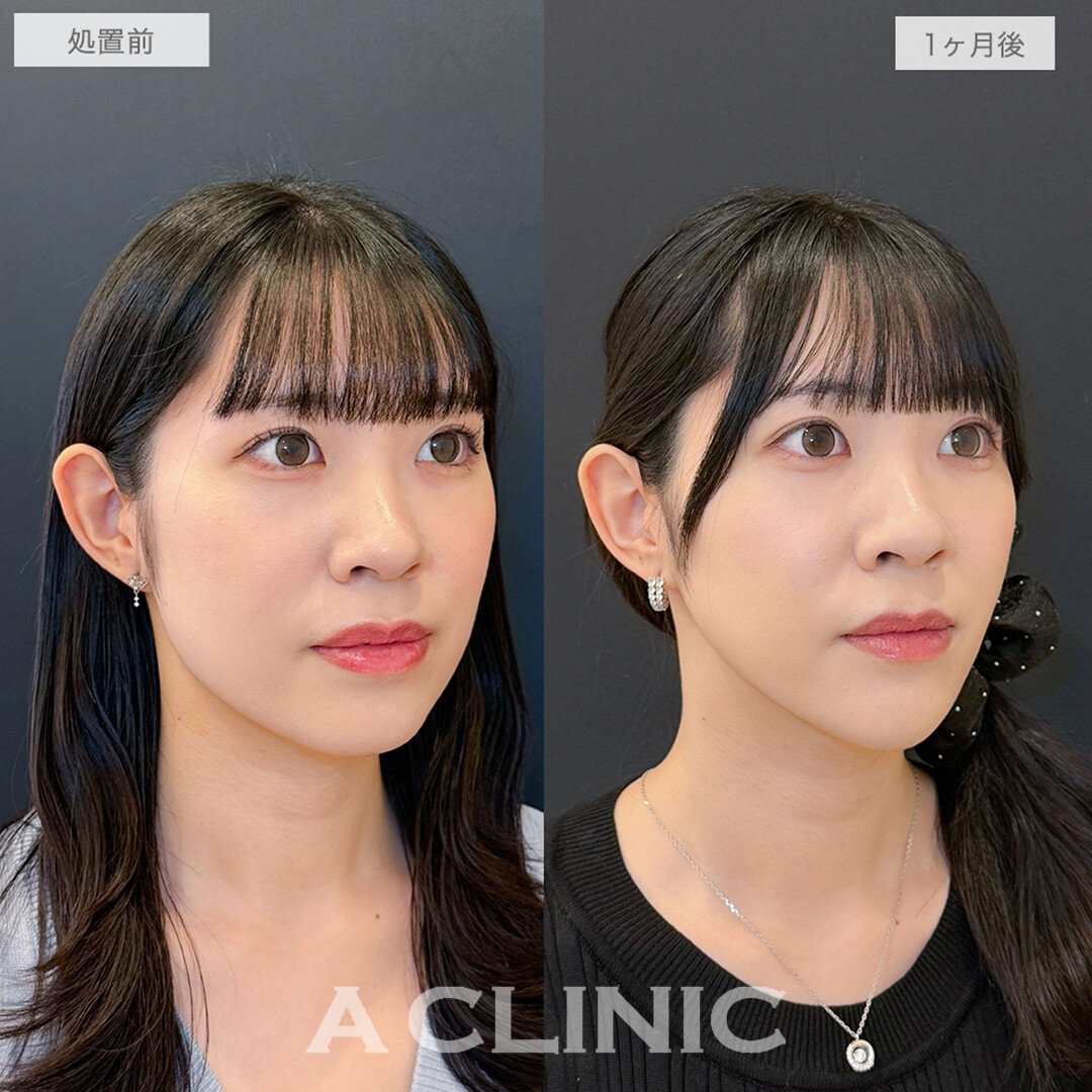 1day小顔脂肪吸引と小顔エラボトックスとあごへのヒアルロン酸注入でフェイスラインのもたつきが消え綺麗なVフェイスが誕生！処置前と1ヶ月後の症例です(20代女性)