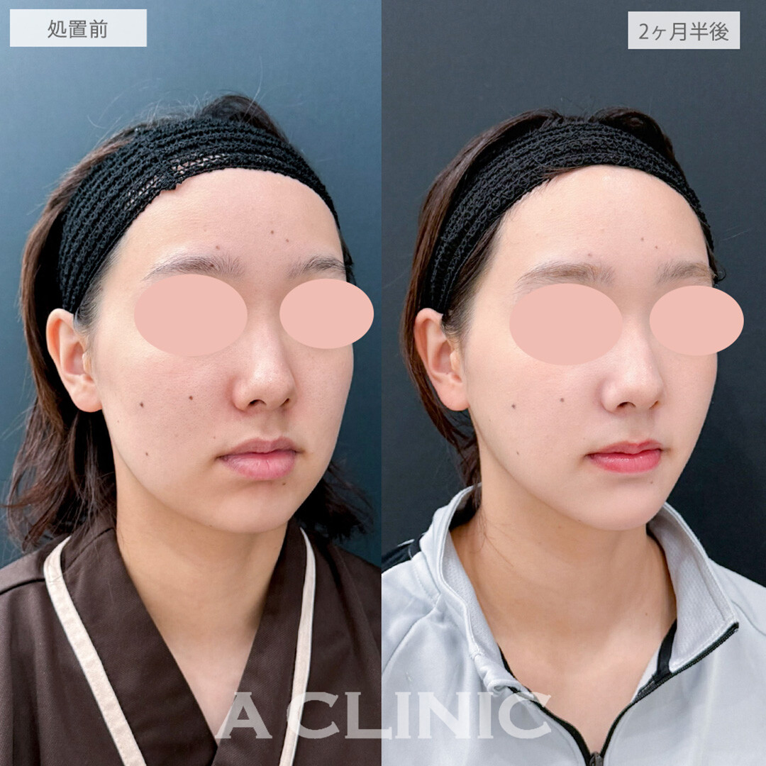 1day小顔脂肪吸引と小顔エラボトックスとあごへのヒアルロン酸注入とボトックス注射(しわ)でぼやけていた輪郭がくっきりとシャープなお顔になりました！処置前と2ヶ月半後の症例です(20代女性)