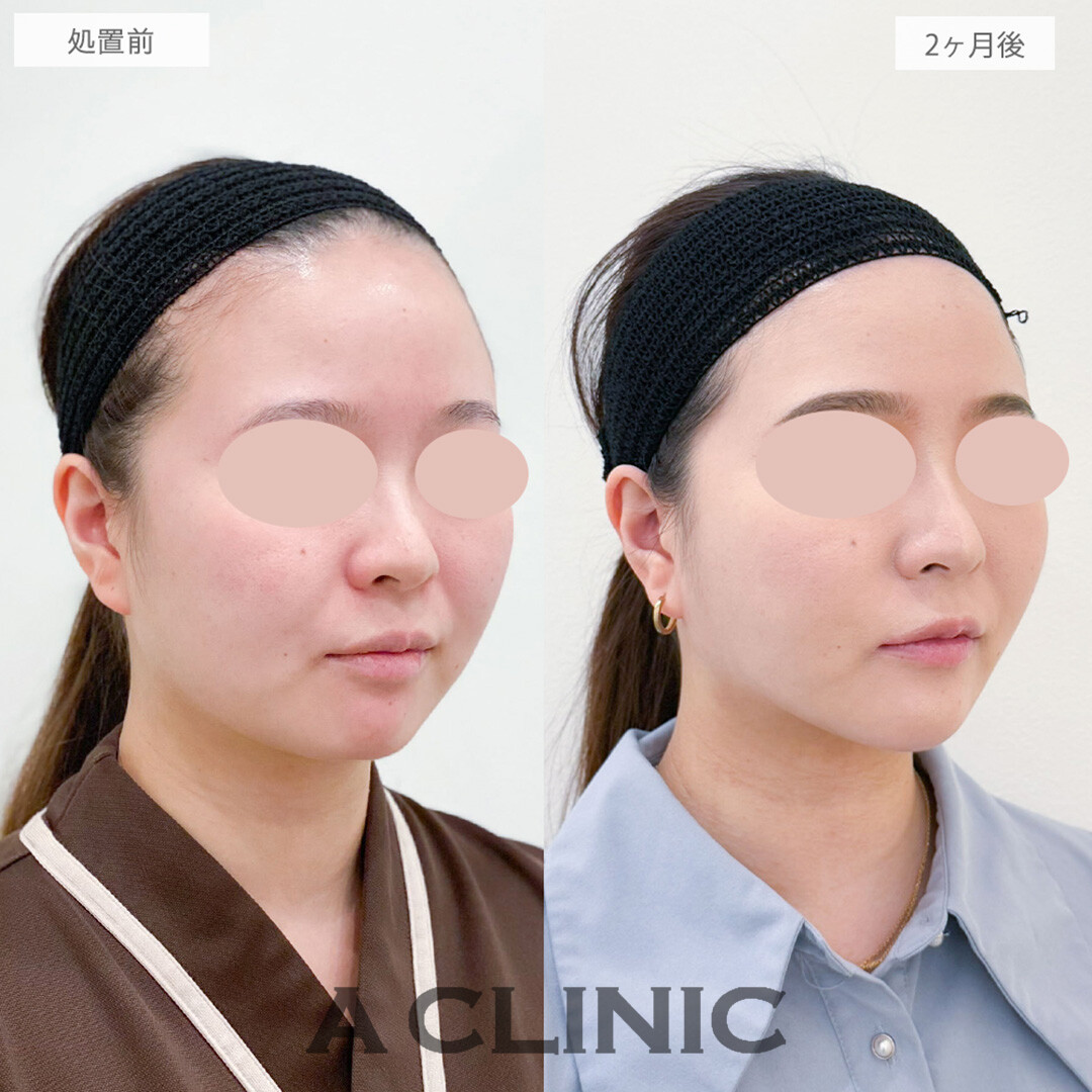 1day小顔脂肪吸引とバッカルファット除去術とナゾラビアルファット除去術と小顔エラボトックスとあごへのヒアルロン酸注入で骨切りいらずの理想の小顔を手に入れました！処置前と2ヶ月後の症例です(20代女性)