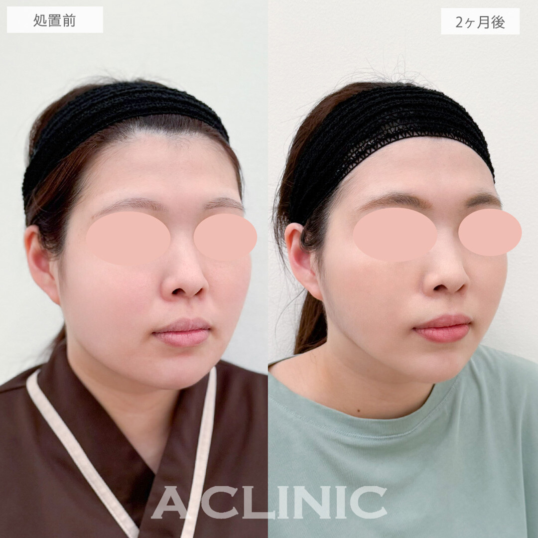 1day小顔脂肪吸引と小顔エラボトックスで下膨れ顔から輪郭美人に！処置前と2ヶ月後の症例です(30代女性)