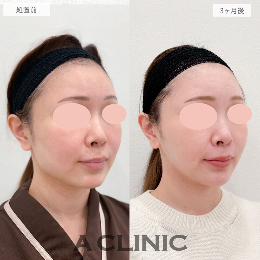 1day小顔脂肪吸引とバッカルファット除去術と小顔エラボトックスとあごへのヒアルロン酸注入でホホのたるみとボリュームがなくなりマイナス10歳若返りました！処置前と3ヶ月後の症例です(40代女性)