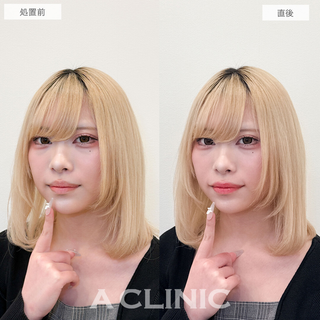 スマイルリップで加工後のような唇が手に入りました！処置前と直後の症例です(10代女性)