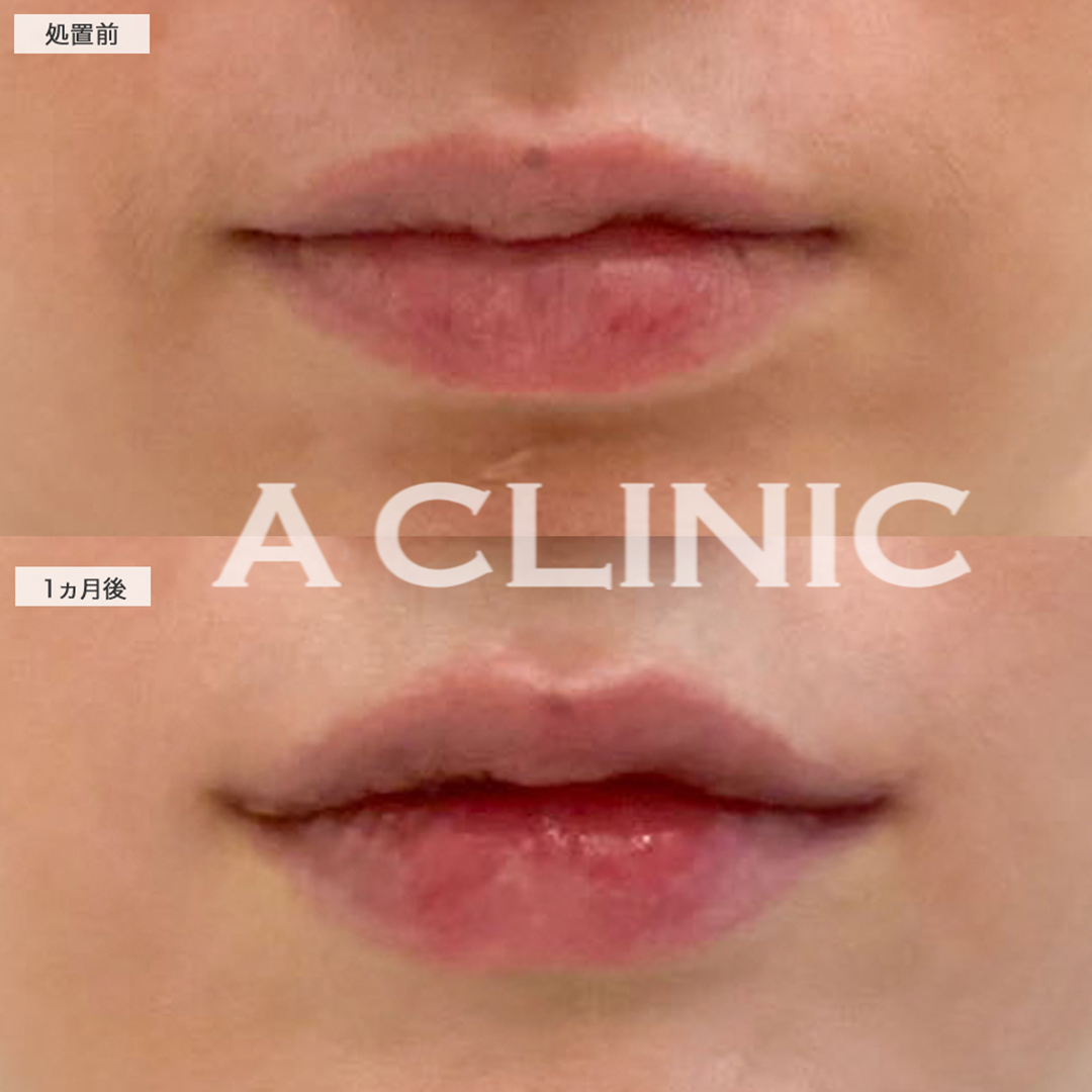 口角挙上(スマイルリフト)で真顔でも可愛い口元になりました！こちら処置前と1ヶ月後の症例です(30代女性)
