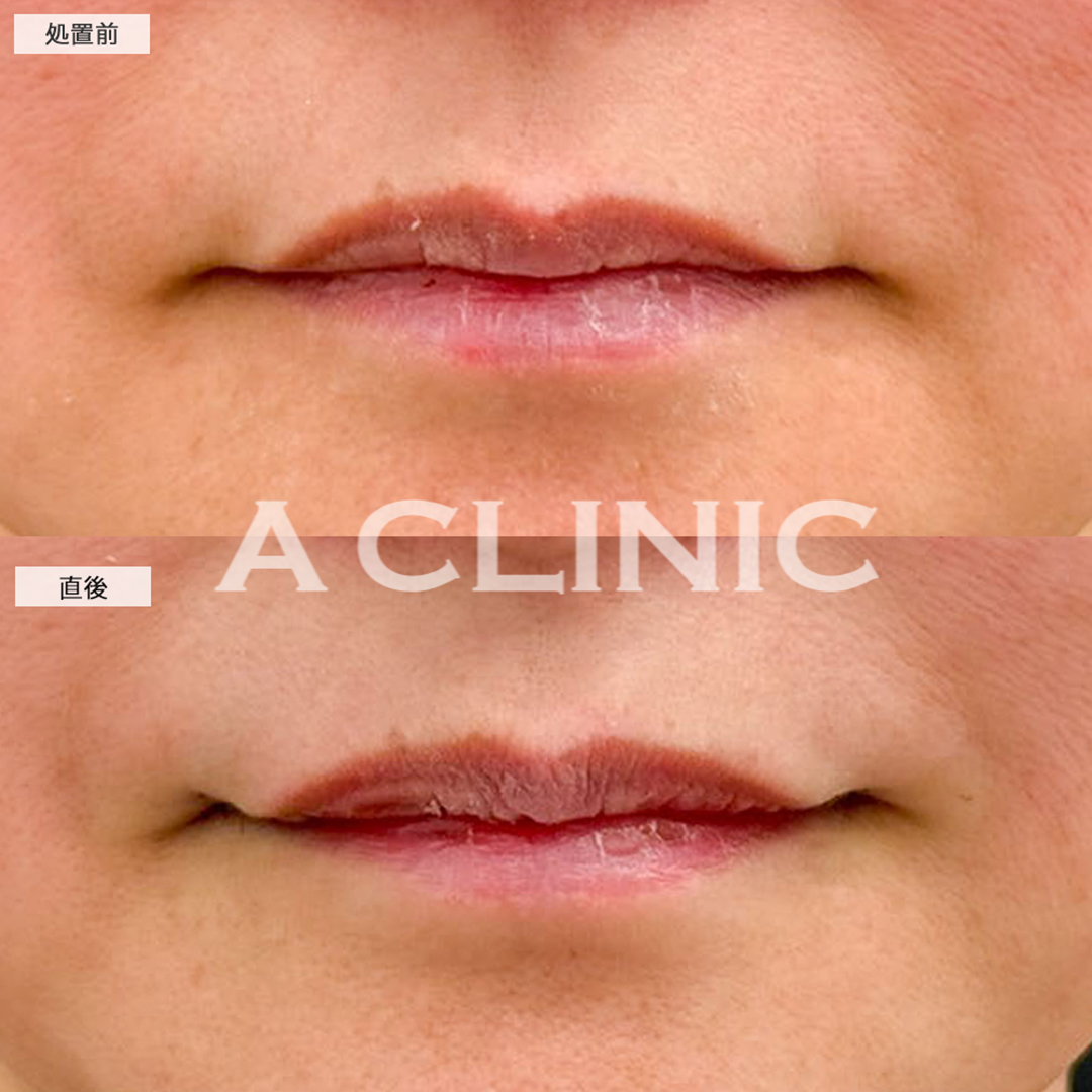 口角挙上(スマイルリフト)で直後から口角がキュッと上がり可愛い印象に！こちら処置前と直後の症例です(40代女性)